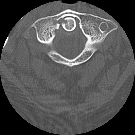 Crowned Dens Syndrome Consultant360